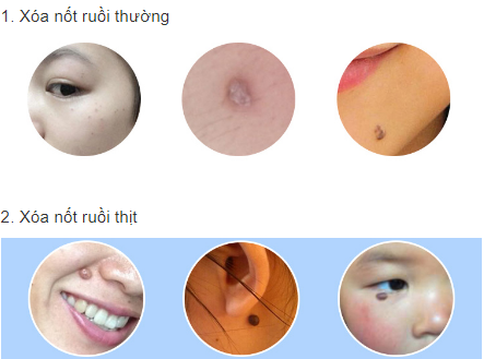 xóa nốt ruồi bằng bút có màn hình